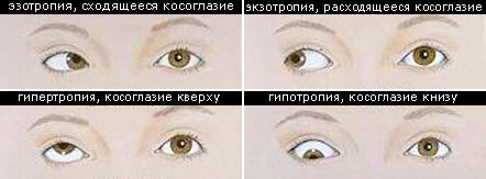 Виды косоглазия